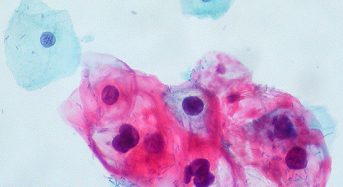 Tumori Papillomavirus: non solo tumore alla cervice ed alla bocca